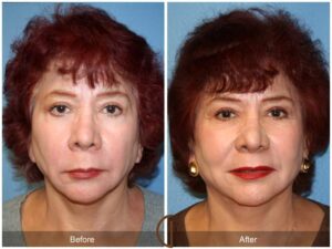 Facial Fat Grafting Laguna Beach CA