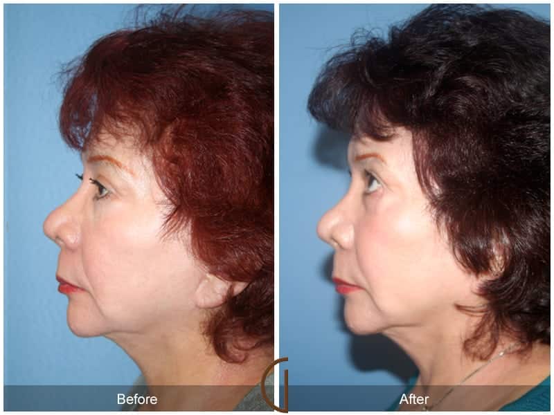 Facial Fat Grafting Laguna Beach CA 58 Image