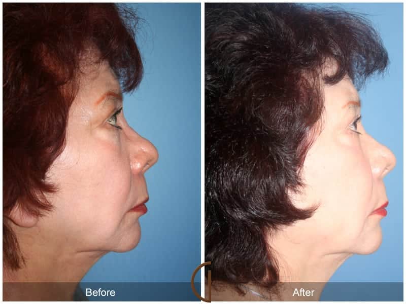Facial Fat Grafting Laguna Beach CA 58 Image
