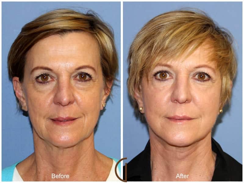Facial Fat Grafting Long Beach CA 51 Image