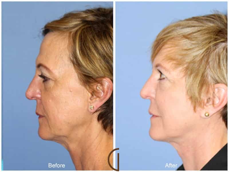 Facial Fat Grafting Long Beach CA 51 Image
