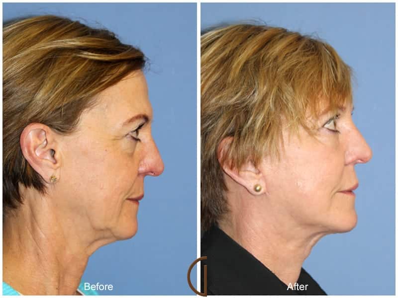 Facial Fat Grafting Long Beach CA 51 Image