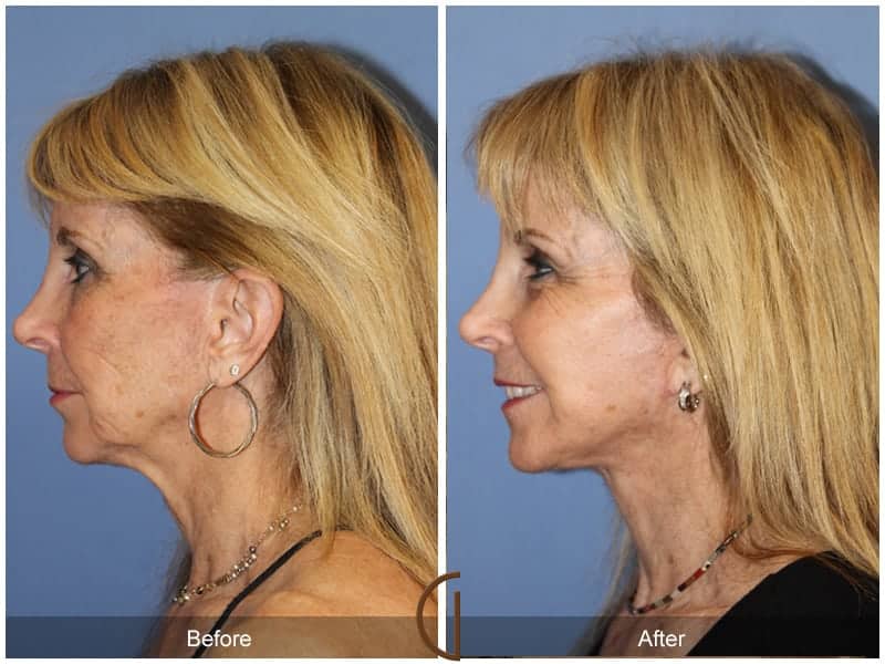 Facial Fat Grafting Los Angeles Image