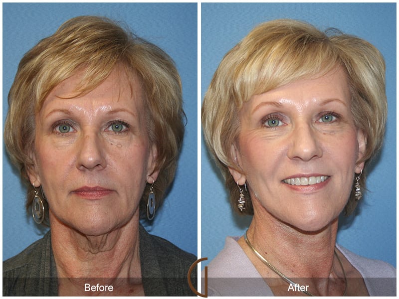 Facial Fat Grafting Mission Viejo CA 53 Image