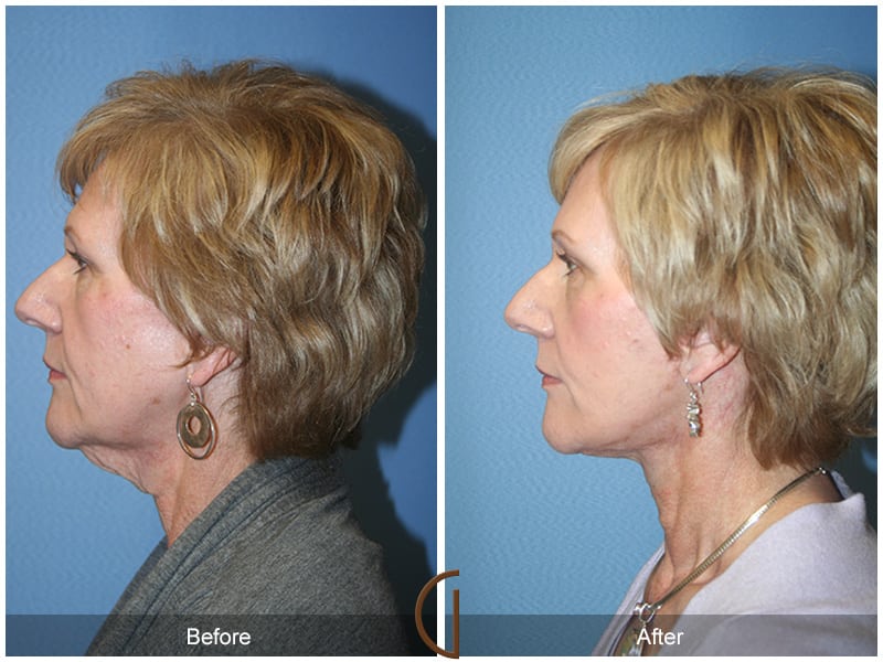 Facial Fat Grafting Mission Viejo CA 53 Image
