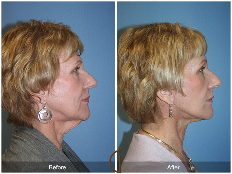Facial Fat Grafting Mission Viejo CA 53 Image