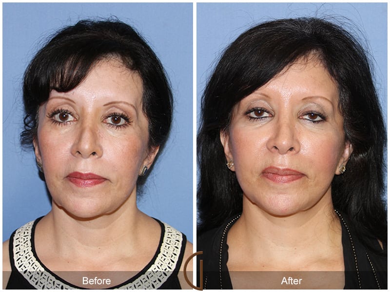 Facial Fat Grafting Newport Beach 57 Image