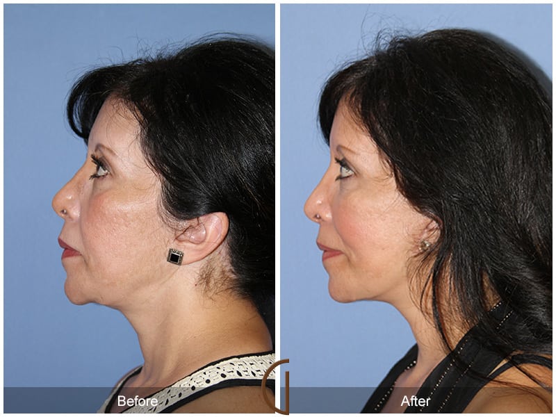Facial Fat Grafting Newport Beach 57 Image