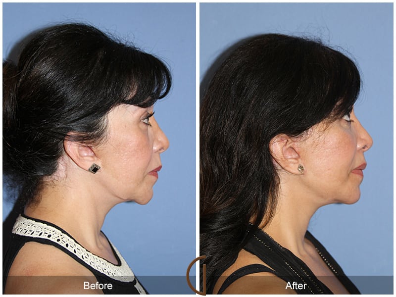 Facial Fat Grafting Newport Beach 57 Image