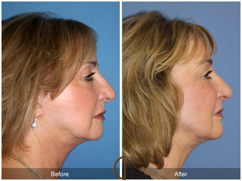 Facial Fat Grafting North Tustin CA 20 Image