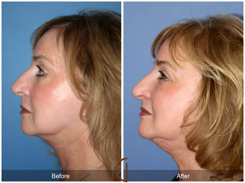Facial Fat Grafting North Tustin CA 20 Image