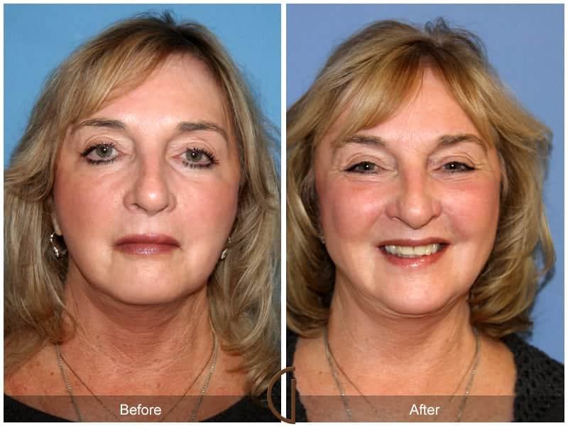 Facial Fat Grafting North Tustin CA 20 Image