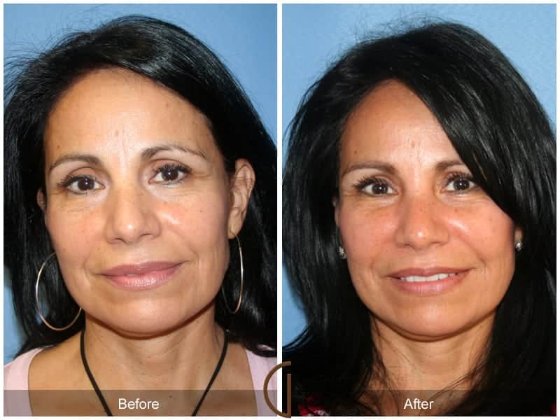 Facial Fat Grafting Orange CA 16 Image