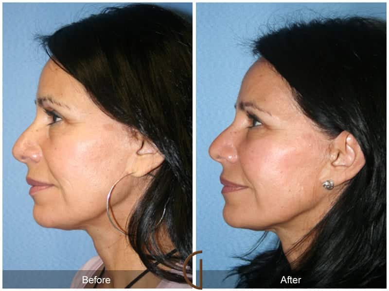 Facial Fat Grafting Orange CA 16 Image
