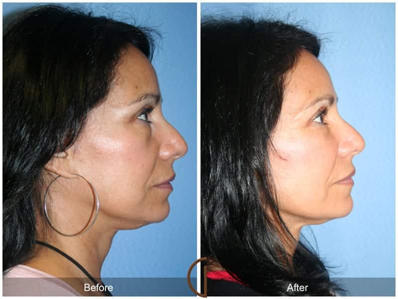 Facial Fat Grafting Orange CA 16 Image