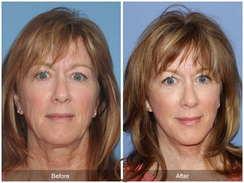 Facial Fat Grafting Orange County CA 56 Image