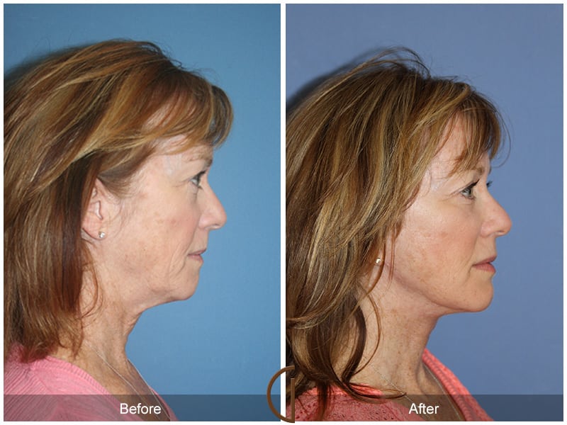 Facial Fat Grafting Orange County CA 56 Image