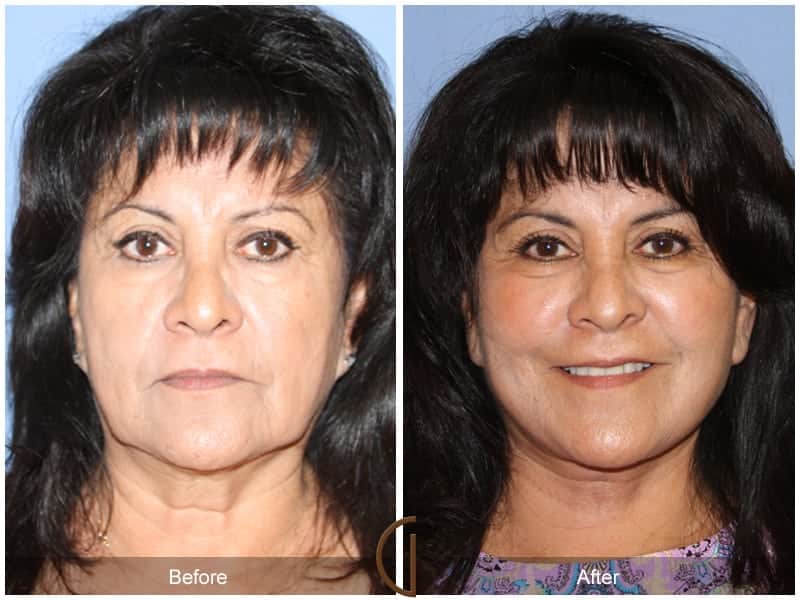 Facial Fat Grafting San Diego CA 55 Image
