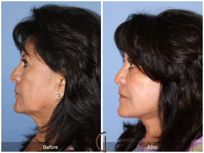 Facial Fat Grafting San Diego CA 55 Image