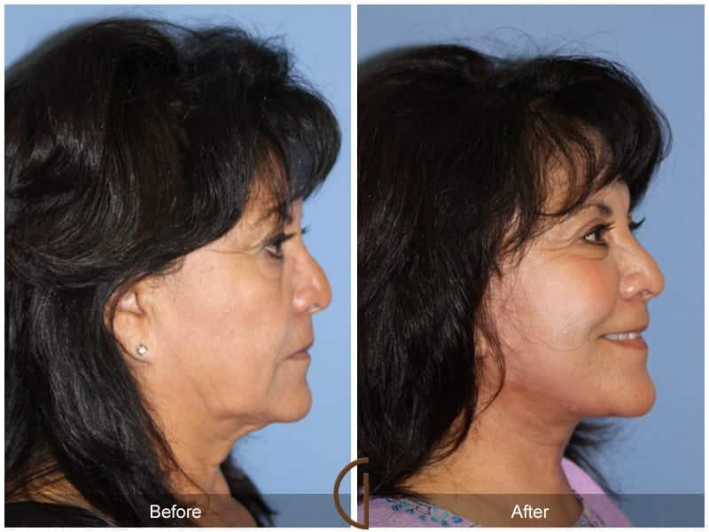 Facial Fat Grafting San Diego CA 55 Image