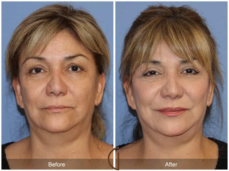 Facial Fat Grafting San Juan Capistrano CA 17 Image