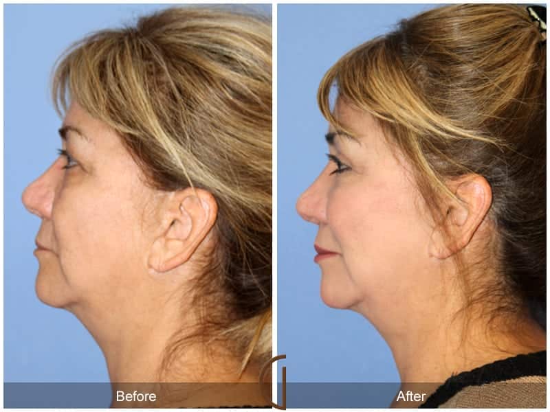Facial Fat Grafting San Juan Capistrano CA 17 Image