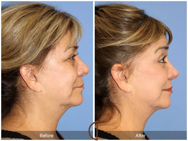 Facial Fat Grafting San Juan Capistrano CA 17 Image