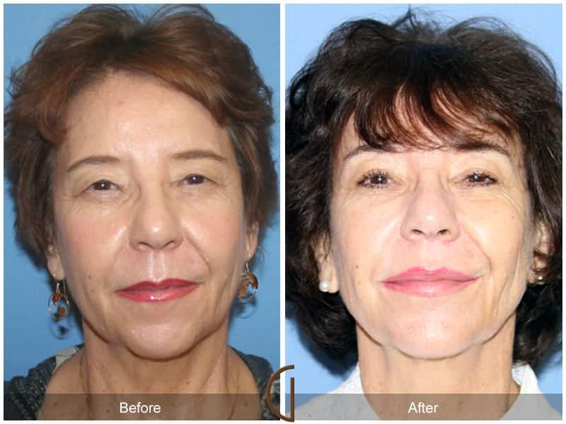 Facial Fat Grafting Santa Ana CA 60 Image