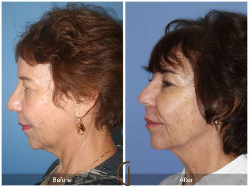 Facial Fat Grafting Santa Ana CA 60 Image