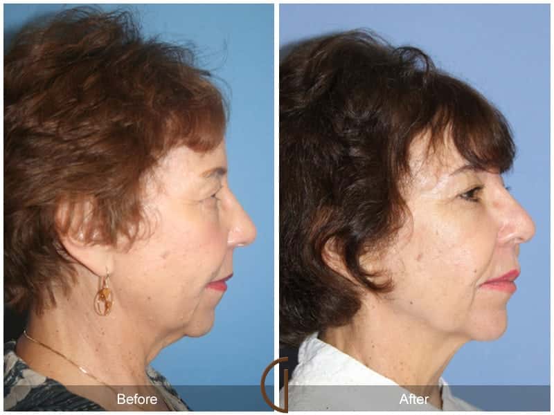Facial Fat Grafting Santa Ana CA 60 Image
