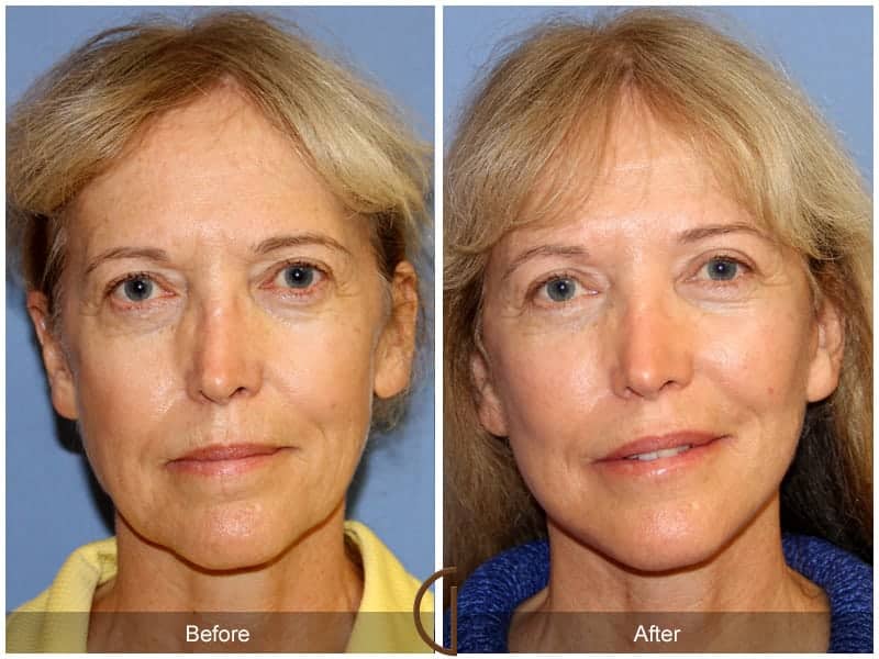 Facial Fat Grafting Santa Monica CA Image