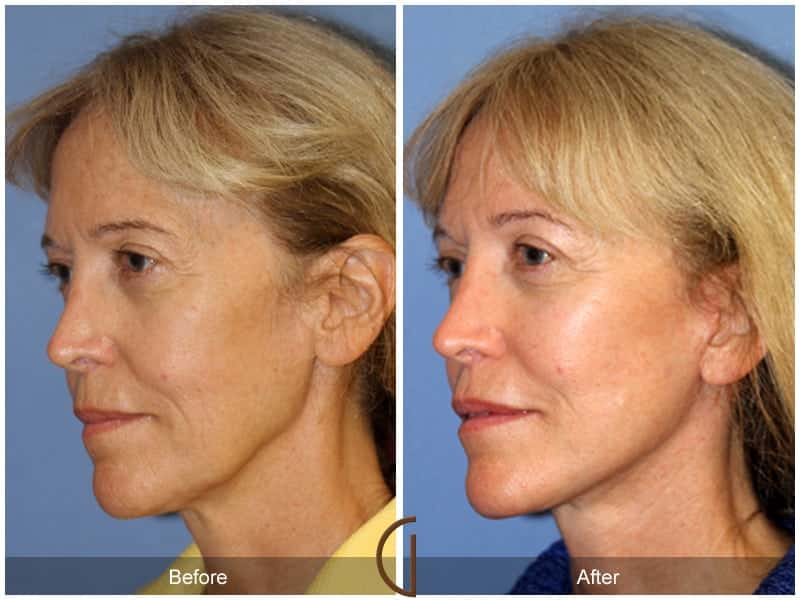 Facial Fat Grafting Santa Monica CA Image