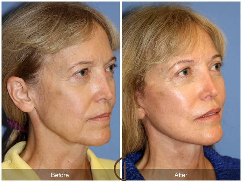 Facial Fat Grafting Santa Monica CA Image