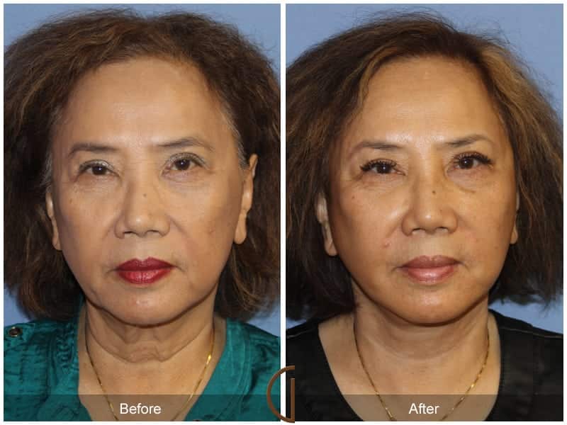 Facial Fat Grafting Tustin CA 18 Image