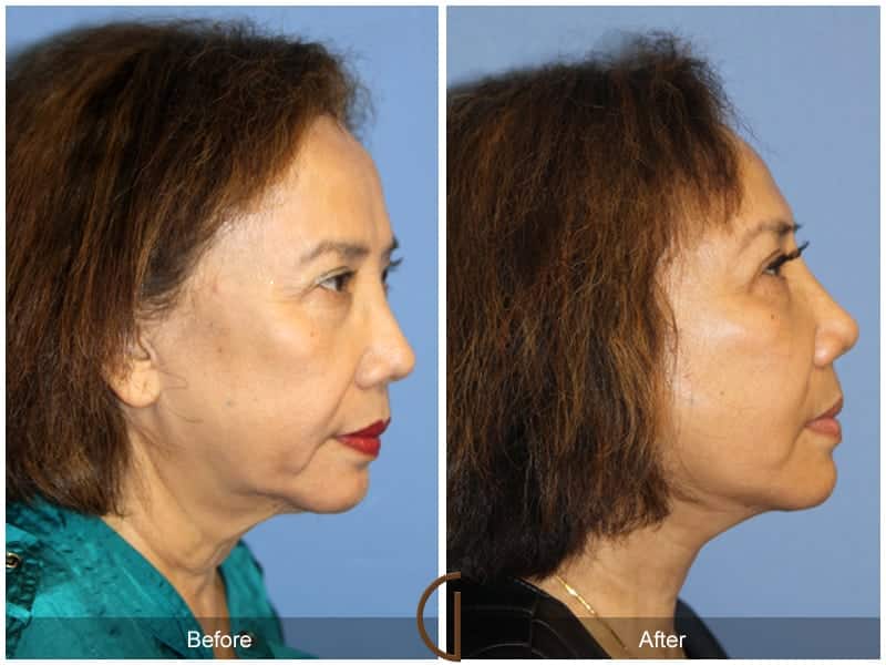 Facial Fat Grafting Tustin CA 18 Image