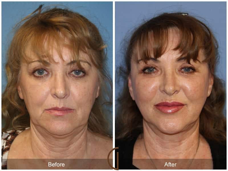 Facial Fat Grafting Villa Park CA 16 Image