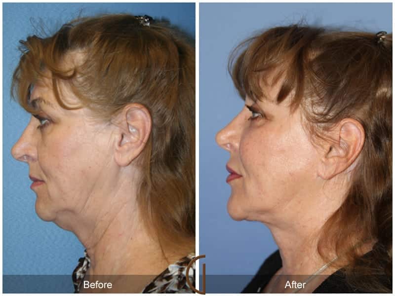 Facial Fat Grafting Villa Park CA 16 Image