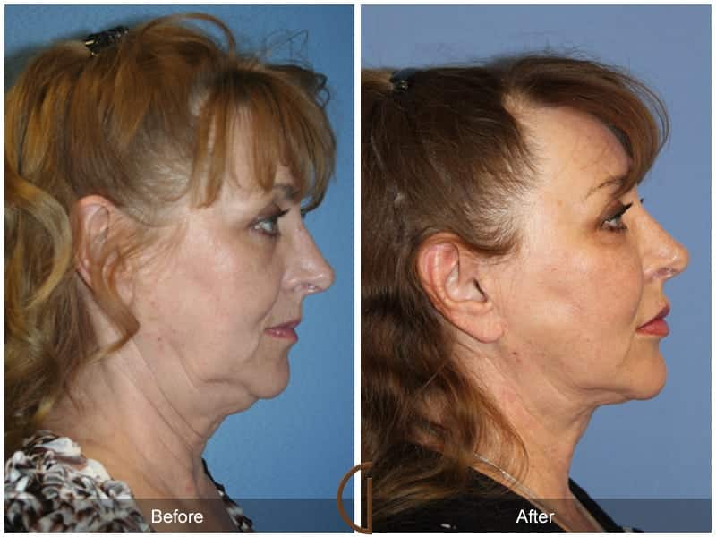 Facial Fat Grafting Villa Park CA 16 Image