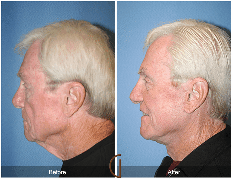 What is the Difference between a Male and Female Facelift? Image