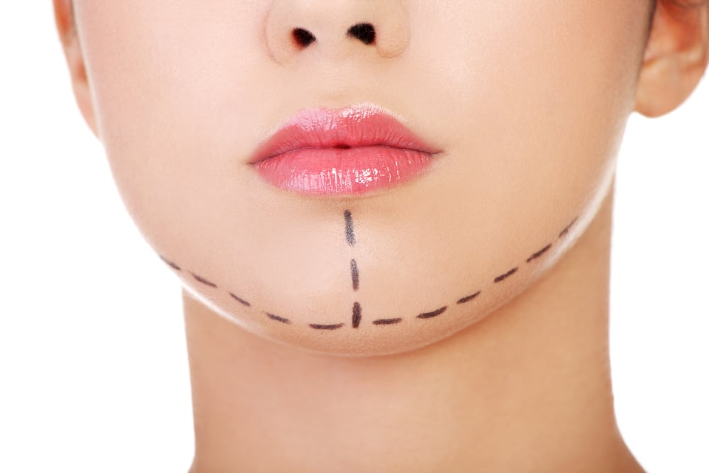Find The Right Chin Implant Surgeon Image