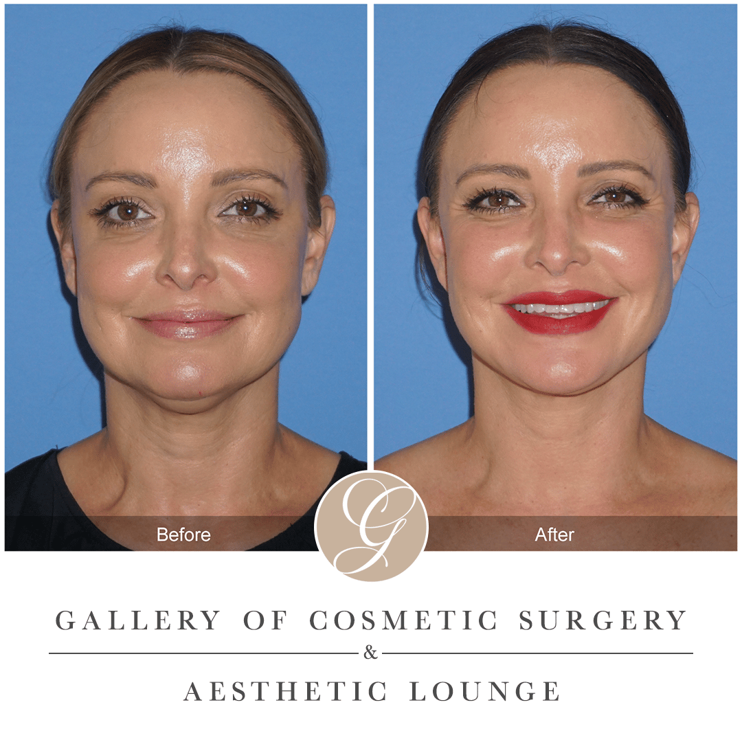 What is Buccal Fat Removal? Image