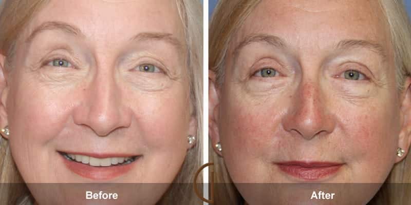 Eyelid Surgery Orange County 49 Image