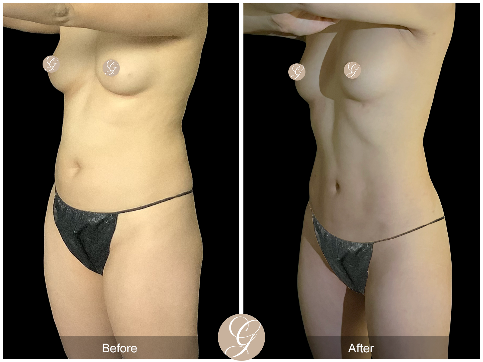 VASER 360 HIGH DEFINITION BODY SCULPTING PT11 Image