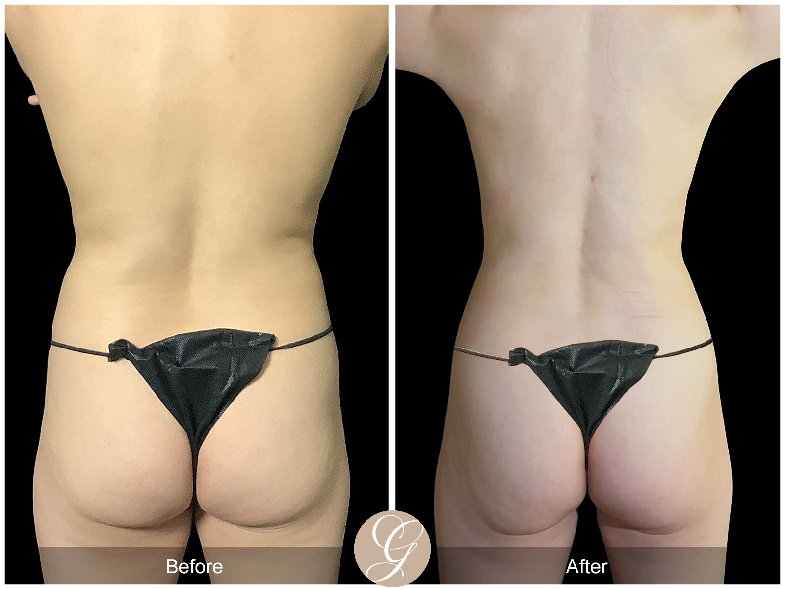 VASER 360 HIGH DEFINITION BODY SCULPTING PT11 Image