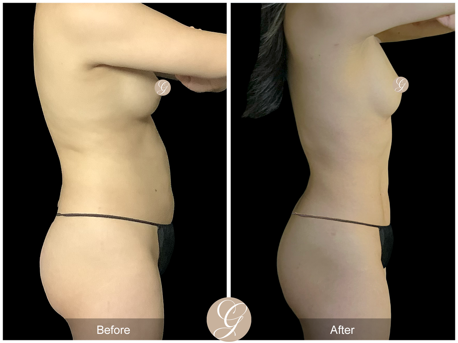 VASER 360 HIGH DEFINITION BODY SCULPTING PT11 Image