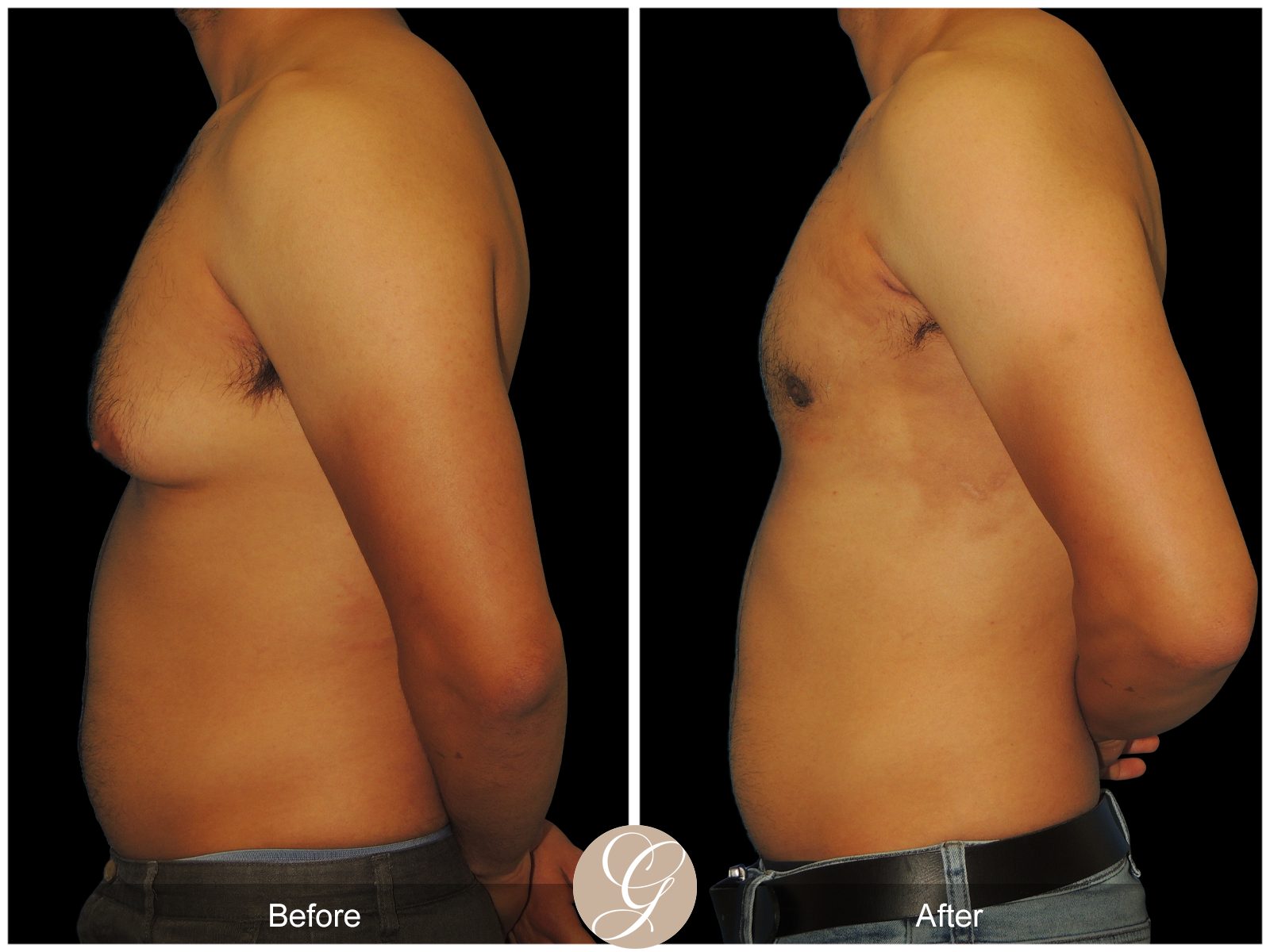 Gynecomastia PT1 Image