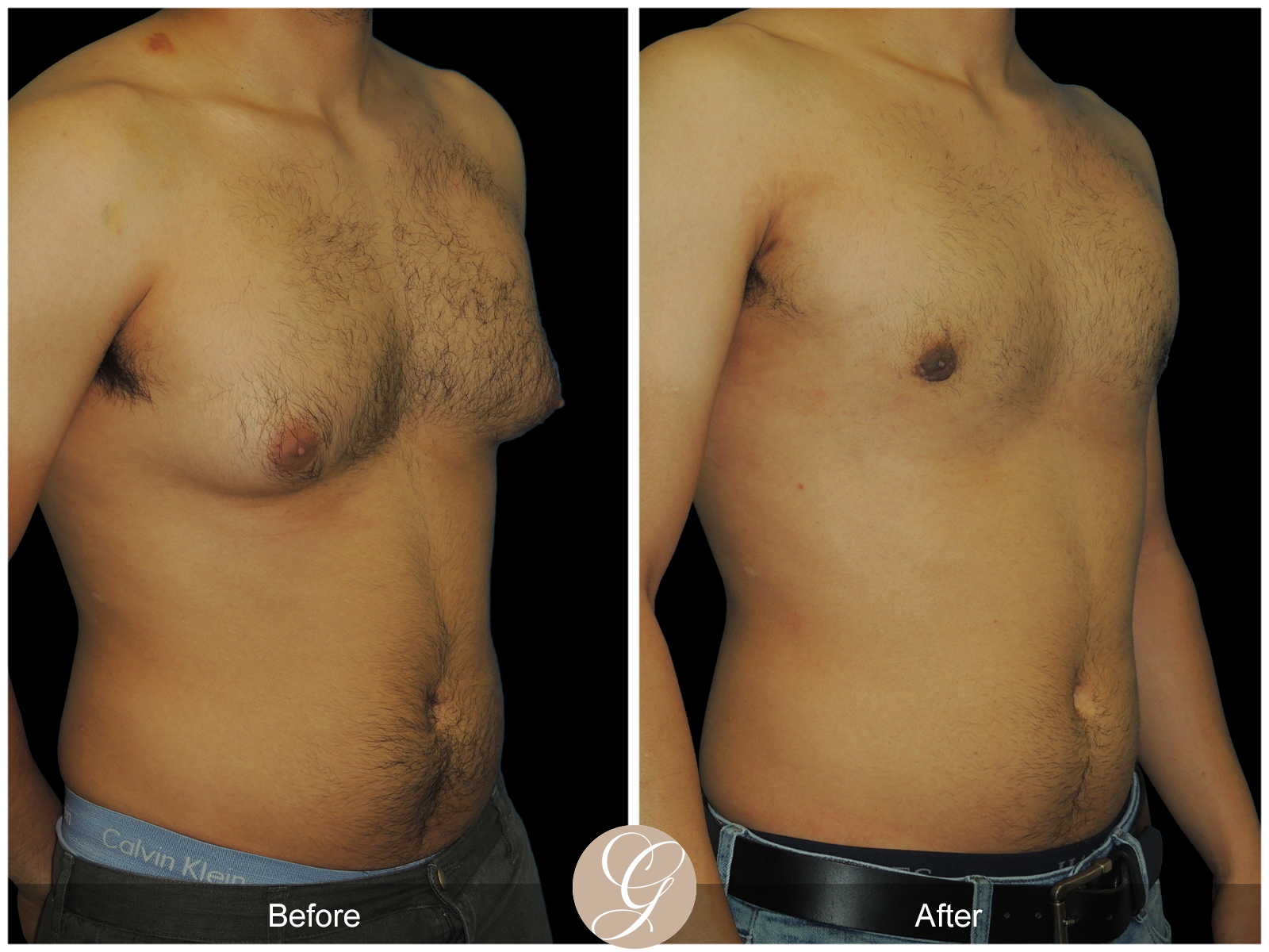 Gynecomastia PT1 Image