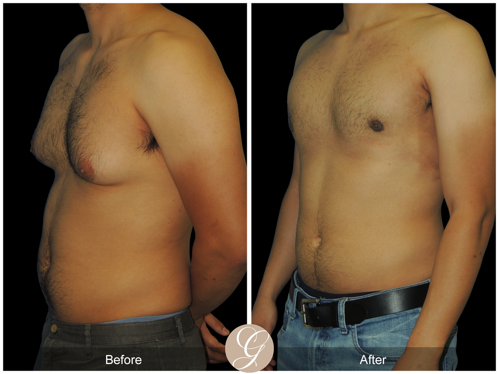 Gynecomastia PT1 Image