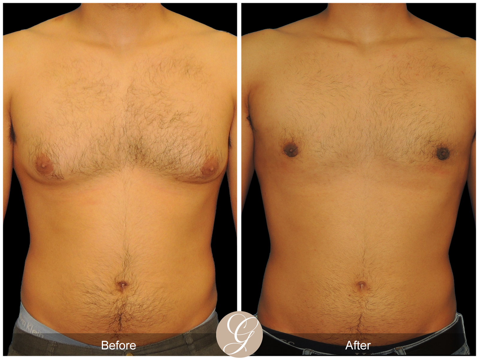 Gynecomastia PT1 Image