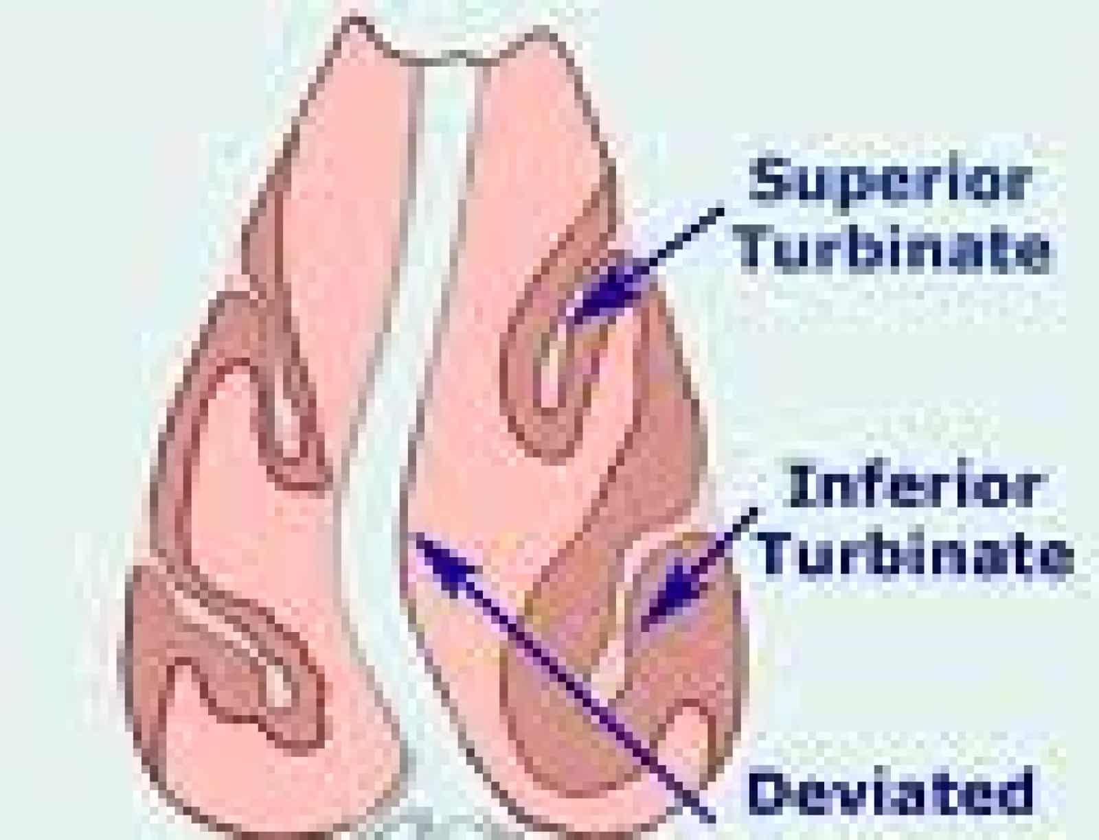 How Do You Correct A Clogged Nose? Image